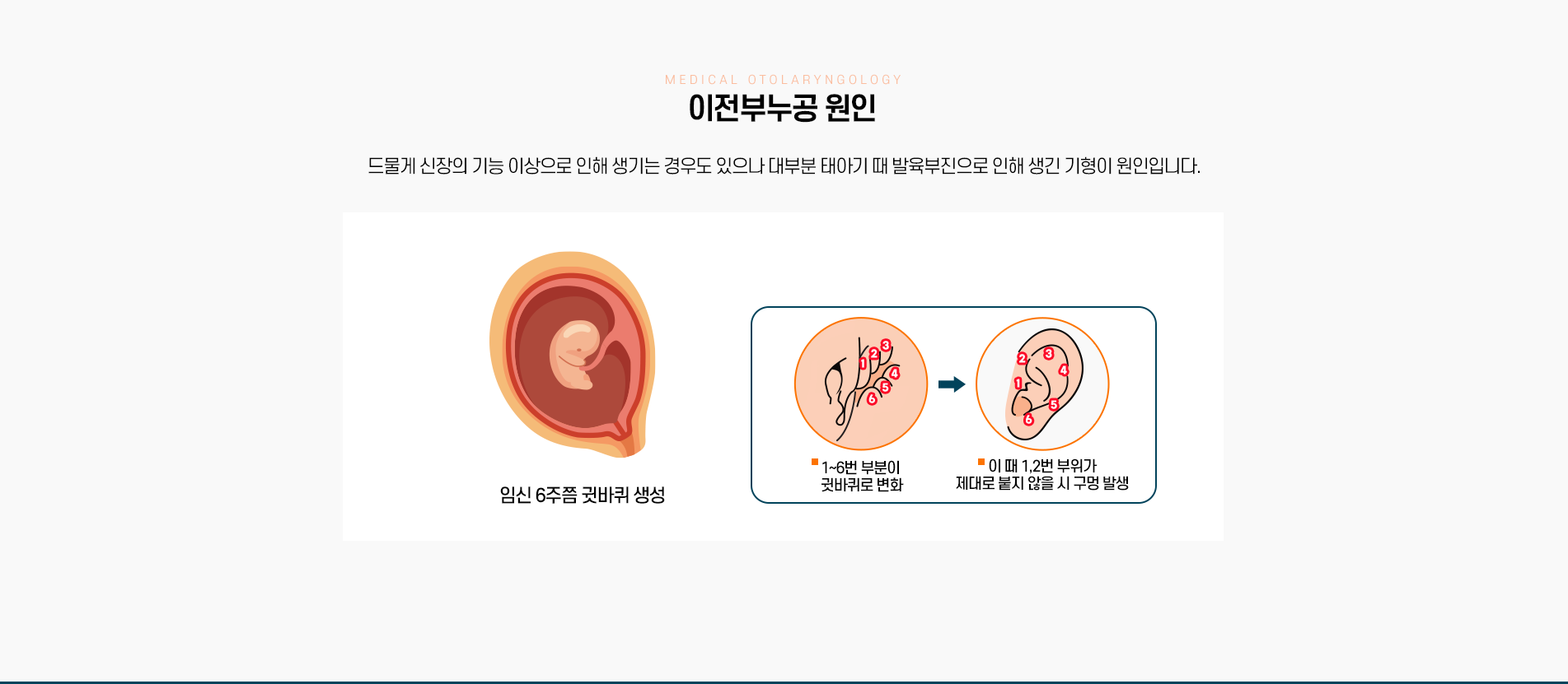 이전부누공 원인