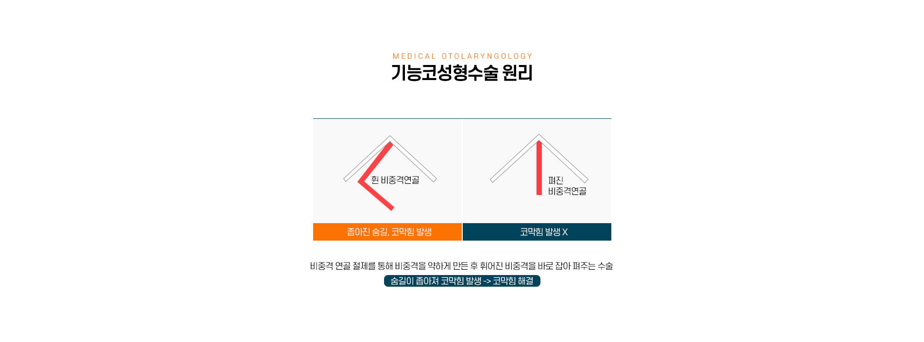 기능코성형수술 원리