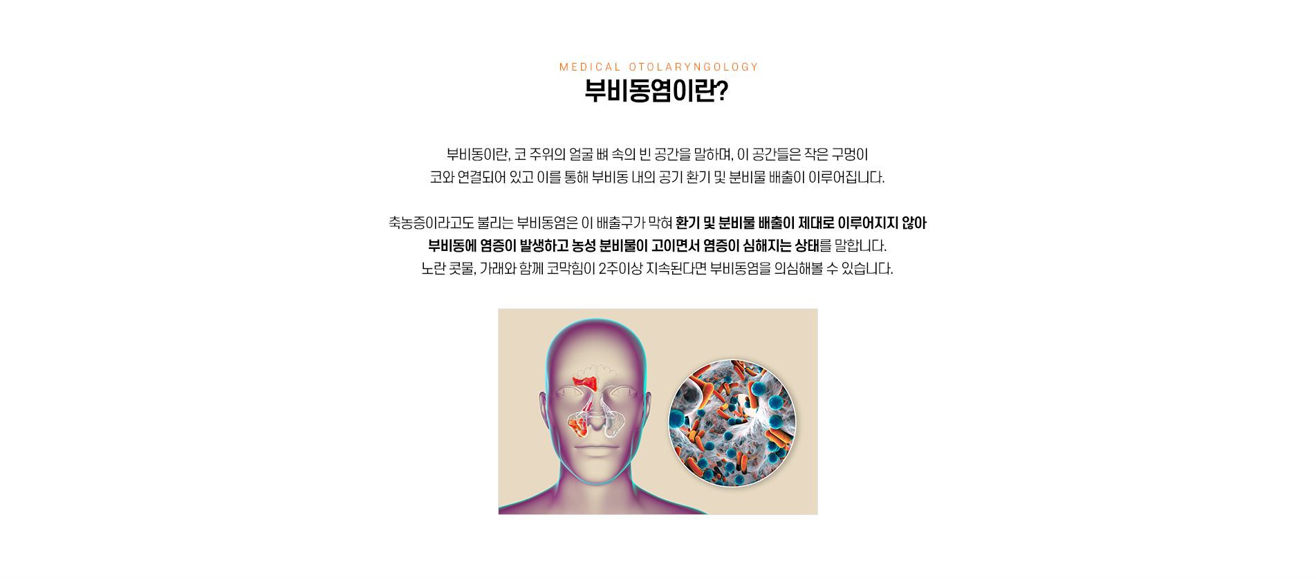 부비동염이란