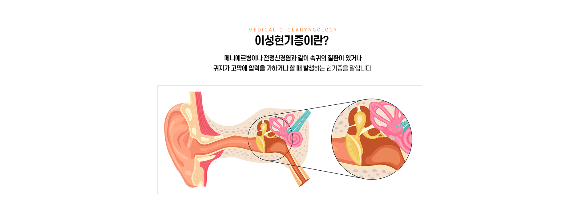 이성현기증이란?